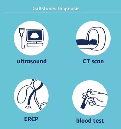 Gallstones diagnosed