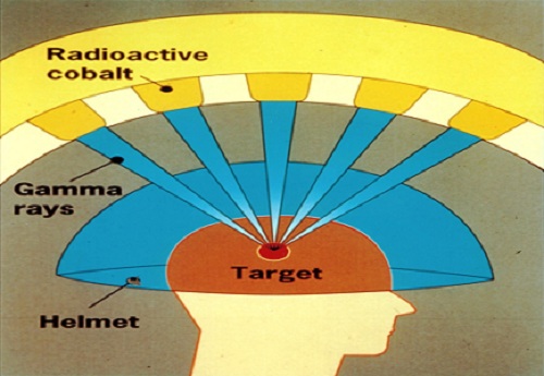 gamma knife surgery gamma knife surgery