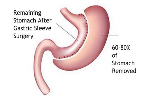 gastric sleeve turkey prices