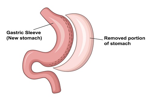 gastric sleeve turkey reviews