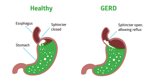 GERD GERD