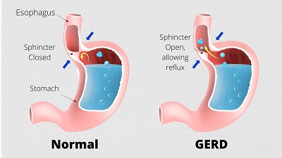 Gastroesophageal Reflux Disease 
