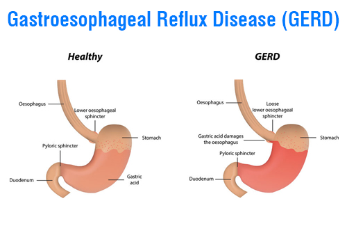 Gastroesophageal Reflux
