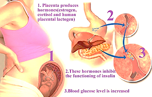 Gestational Diabetes