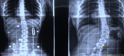 scoliosis scoliosis