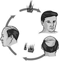 Hair Transplant
