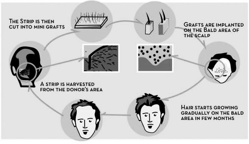 Hair Transplant Procedure