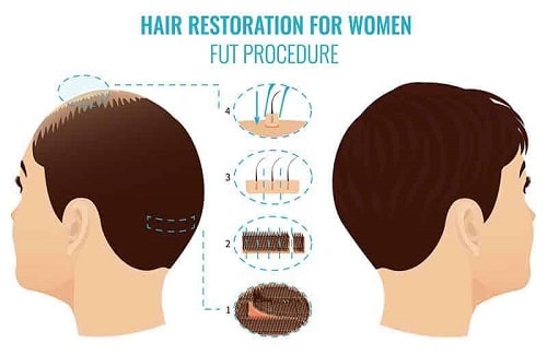 hair transplant in Turkey hair transplant in Turkey