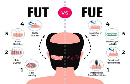 hair transplant in turkey hair transplant in Turkey