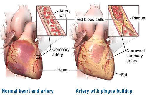 what causes a heart attack? what causes a heart attack?