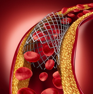 Heart blockage treatment without surgery Heart blockage treatment without surgery