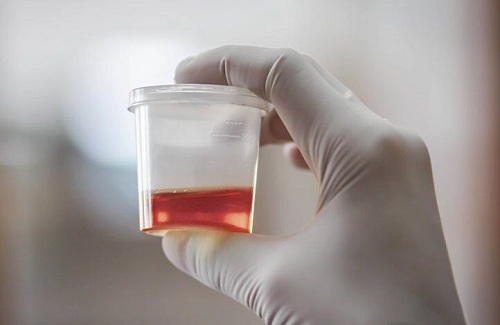 hematuria hematuria