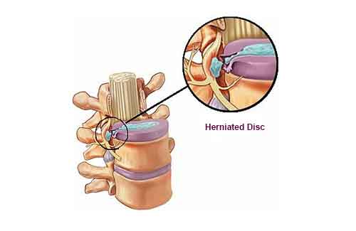 herniated disc herniated disc