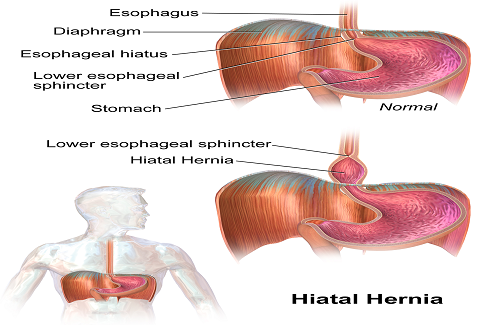hiatal hernia hiatal hernia