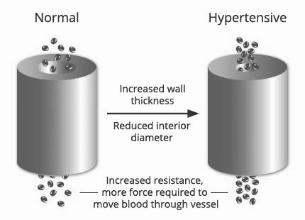 Hypertension