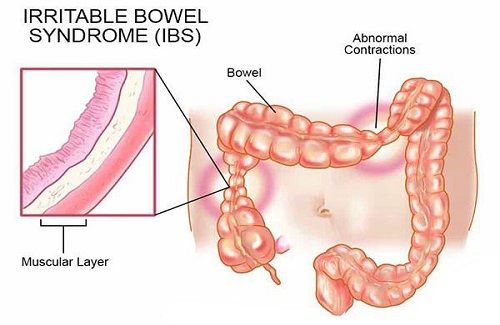 Irritation Bowel Syndrome Irritation Bowel Syndrome