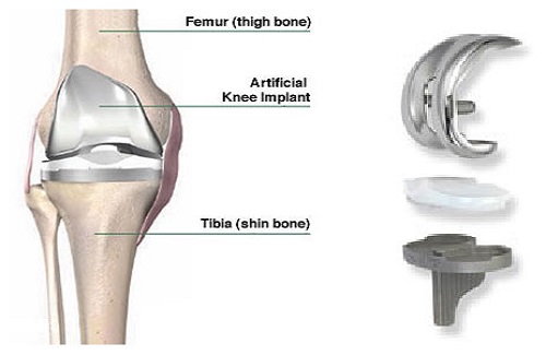 preoperative consultation types of implants