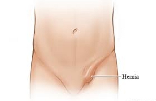Inguinal Hernia Inguinal Hernia