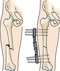 Internal Fixation
