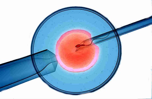 Intra-vitro fertilization Intra-vitro fertilization