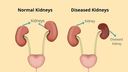 Kidney disorders
