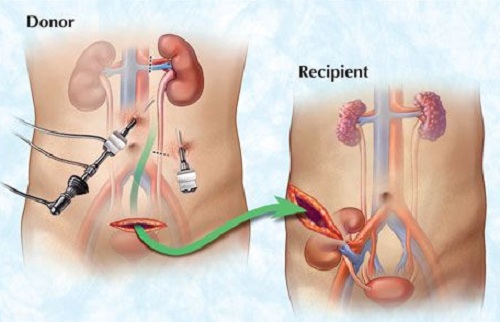 living kidney donation living kidney donation