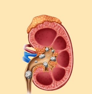 kidney stone