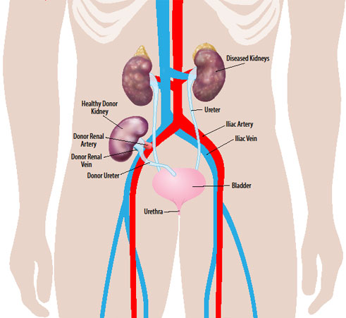 Kidney Transplant