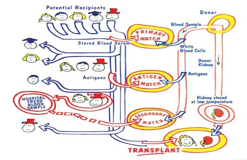 kidney transplant