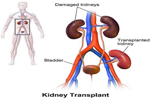 kidney transplant