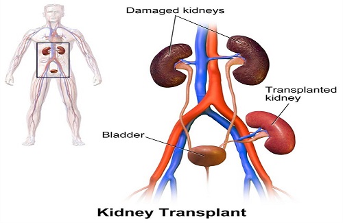 kidney transplant in India kidney transplant in India