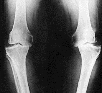 Knee Joint