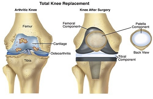 knee replacement surgery cost in india knee replacement surgery cost in india
