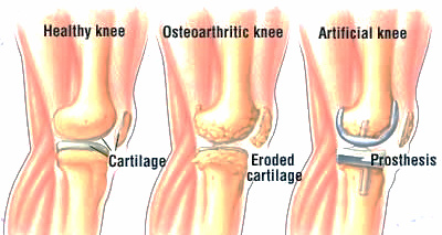 Knee Replacement