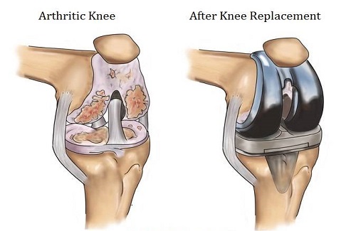 knee replacement surgery in Turkey - Vaidam Health knee replacement surgery in Turkey - Vaidam Health