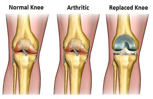 knee replacement surgery in Turkey - Vaidam Health knee replacement surgery in Turkey - Vaidam Health
