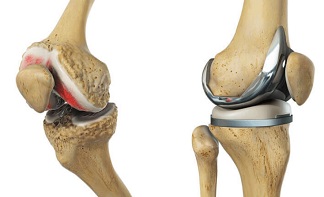Knee Replacement Surgery