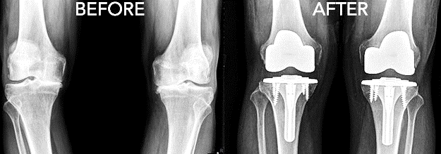 Knee Surgery Before After