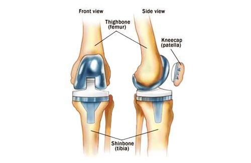 kneecap replacement kneecap replacement