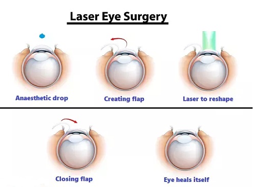 Laser Eye Surgery in Turkey - Vaidam Health Laser Eye Surgery in Turkey - Vaidam Health