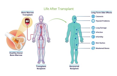 life after transplant life after transplant
