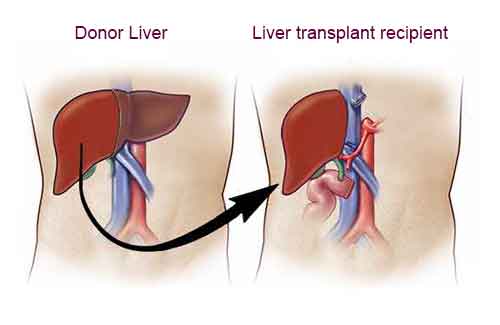 success rate of liver transplant in India success rate of liver transplant in India