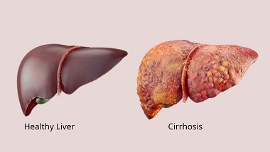 Liver Cirrhosis