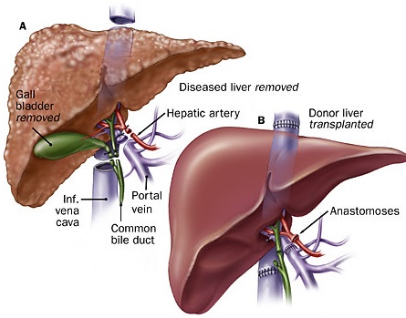 liver transplant in Turkey - Vaidam liver transplant in Turkey - Vaidam