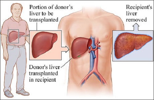 liver transplant liver transplant