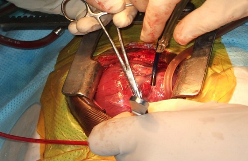 Low cost treatment attract foreign heart patients to India Low cost treatment attract foreign heart patients to India