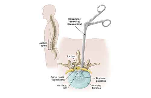 microdiscectomy microdiscectomy