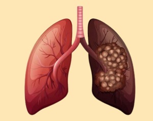 Lung Cancer