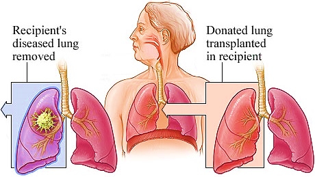 Lung Transplant Procedure