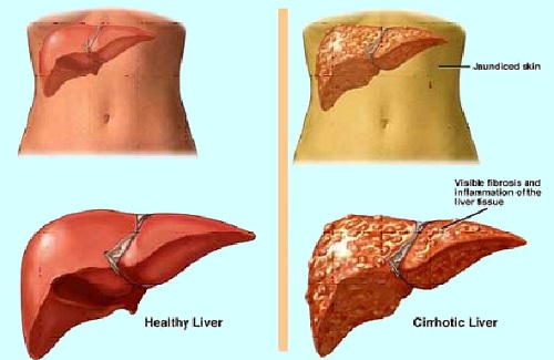 diseased liver diseased liver